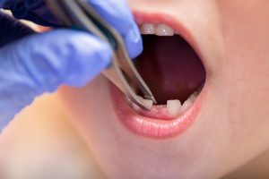 Pediatric Tooth Extraction Escondido, CA