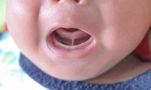 Frenectomy Escondido, CA